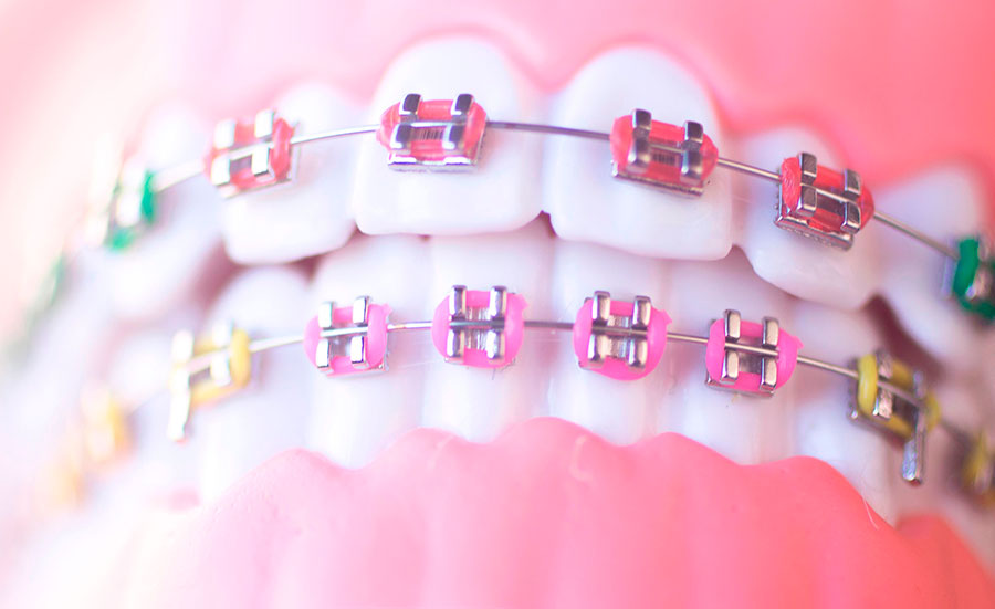 Bracket colores