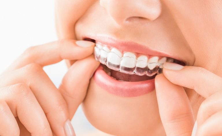 Qué es la ortodoncia removible Ventajas e inconvenientes Vitaldent