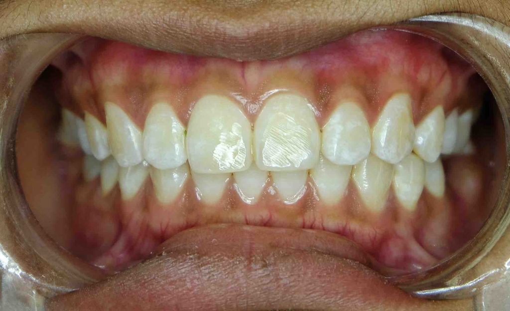 ¿Qué es la fluorosis dental? · Causas y Tratamiento Vitaldent