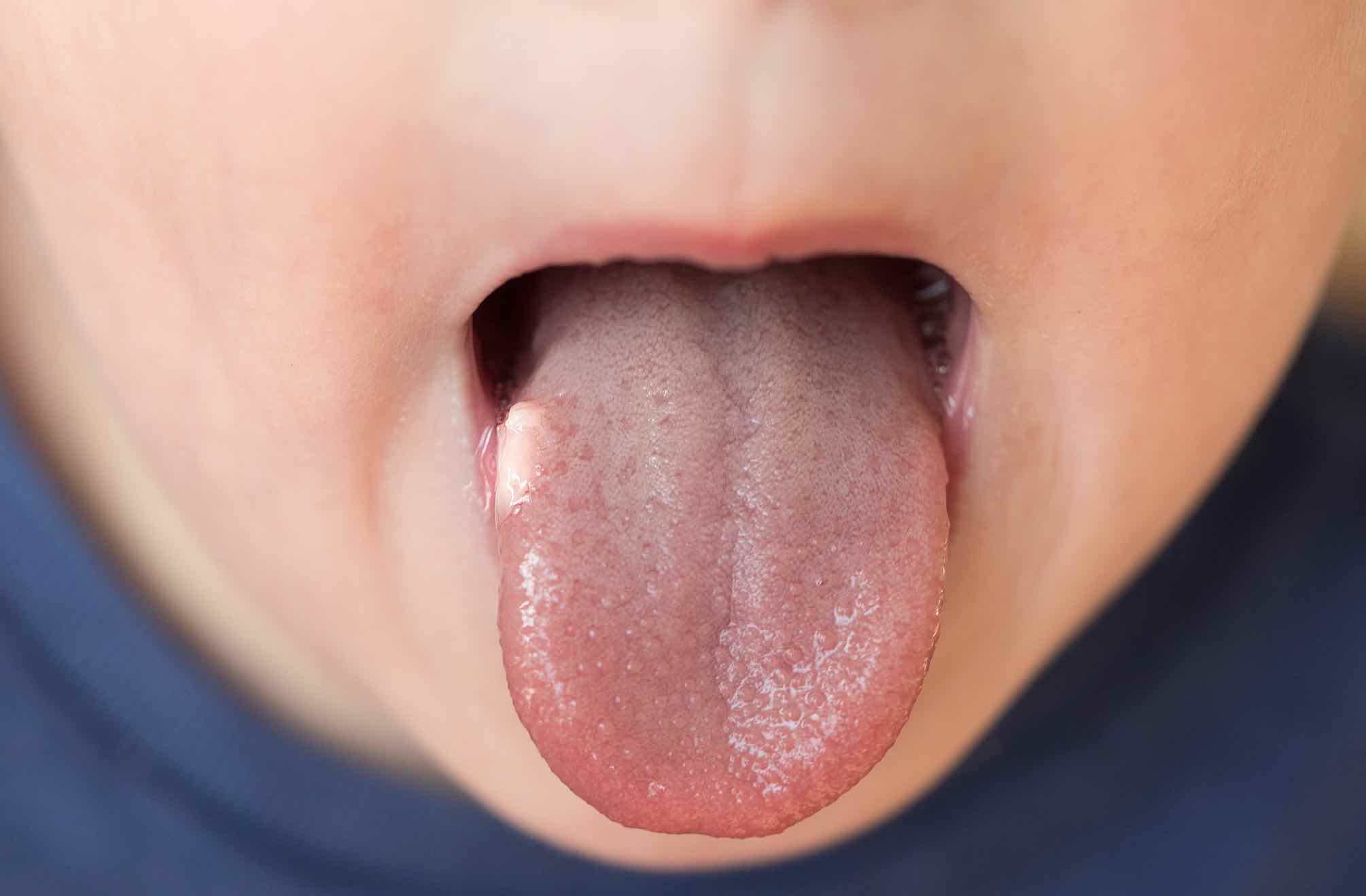 Lesiones en la lengua Trastornos bucales y dentales | Vitaldent