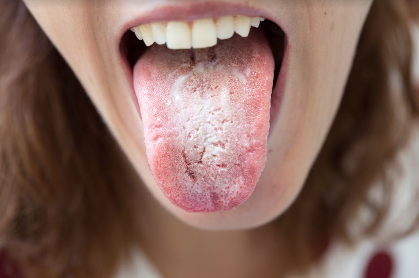 Candidiasis oral