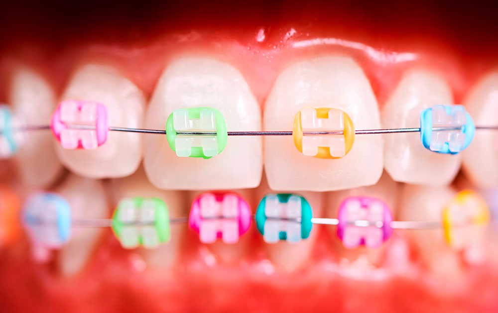 Gomas de ortodoncia, qué sirven y qué tipos existen? - blog de | Hábitos, tratamientos y consejos de Salud Dental