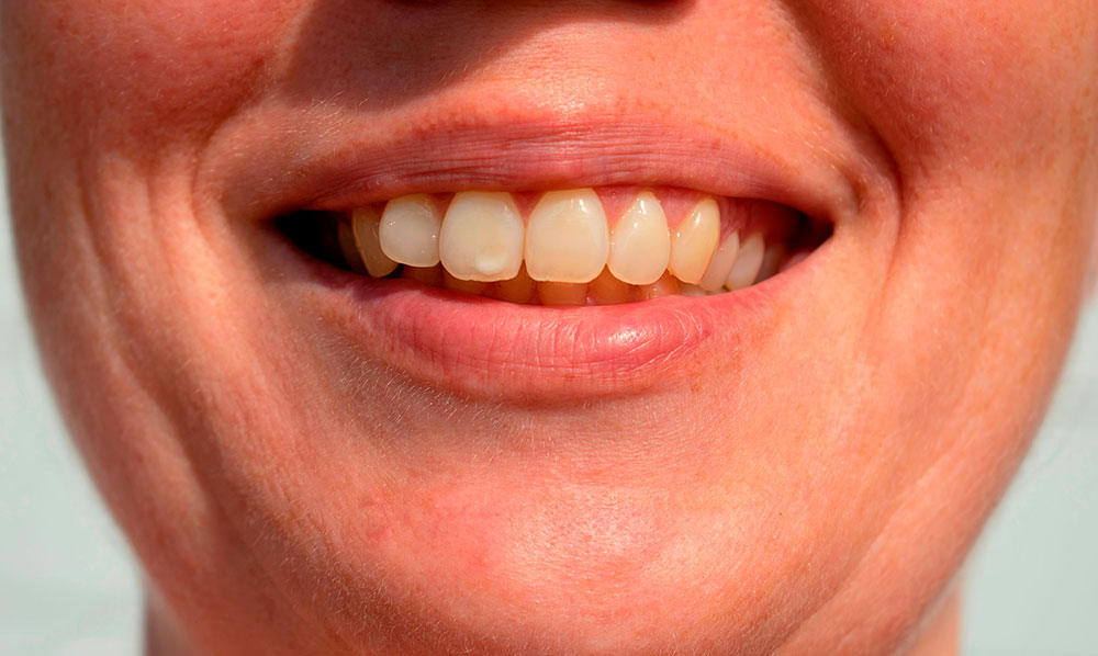 Manchas blancas en los dientes