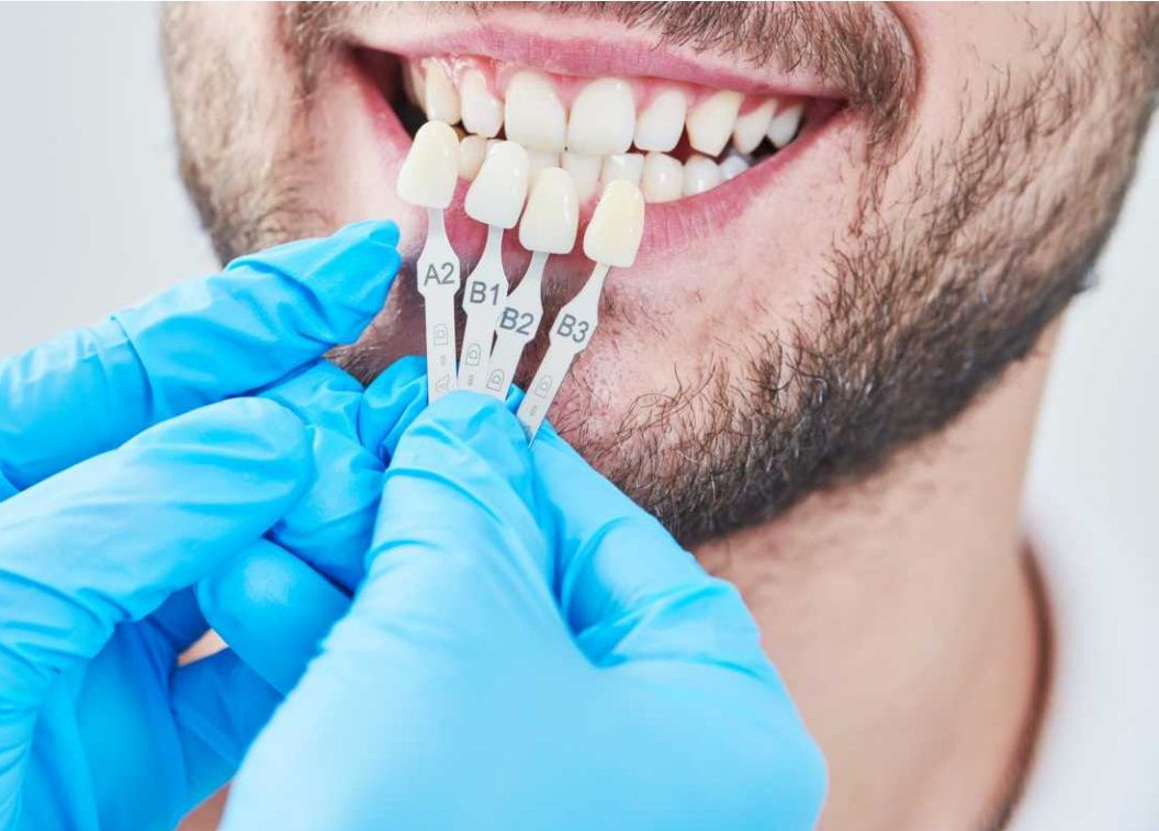 Carillas dentales de composite - Clínica Dental Zahne
