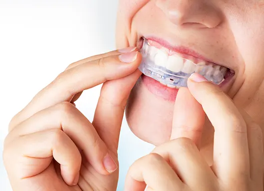 Férula de descarga: qué es y para qué sirve - Amora Clínica Dental