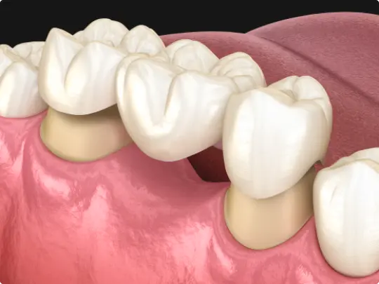 Existen dos tipos de puentes dentales: los puentes sobre dientes y los puentes sobre implantes: Puentes sobre dientes, Puentes sobre implantes