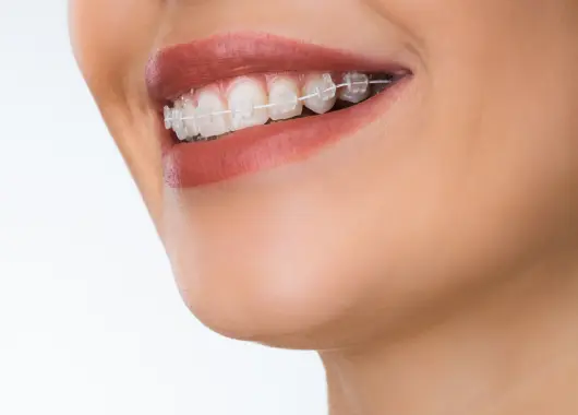 Brackets de zafiro (doble arcada)*