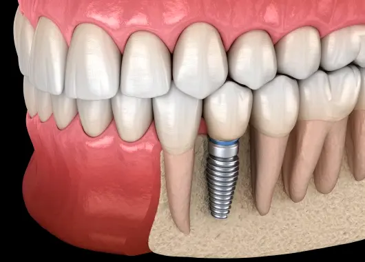 Fases del tratamiento de los implantes de carga inmediata
