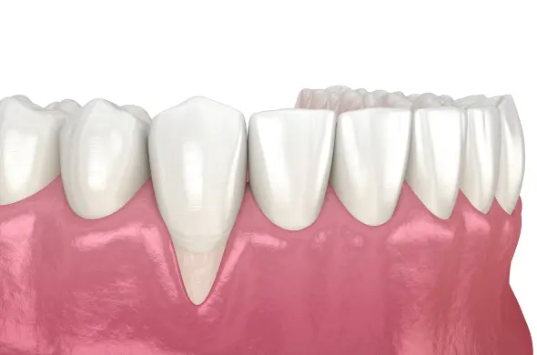 Injerto de hueso dental